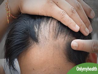 बालों को दोबारा उगाने में मददगार है ये हेयर लॉस ट्रीटमेंट, जानें क्या है ये